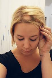 alopecia women