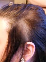 alopecia cicatricial