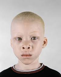 albino africans
