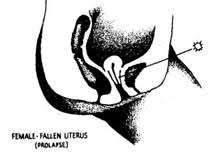 fallen uterus