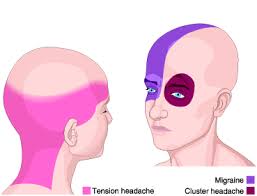 migraine symptoms