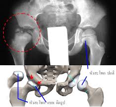 perthes disease