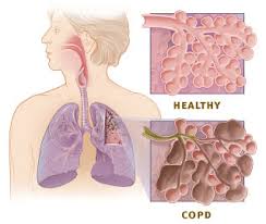 severe copd