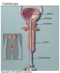 cystoscopy video