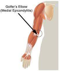 medial epicondylitis