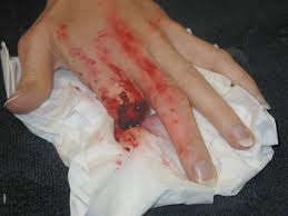 finger cut