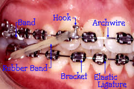 braces pictures