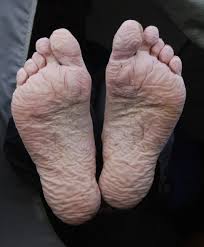 immersion foot