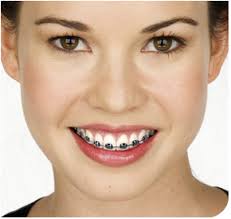 braces care