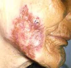 tuberculose miliaire