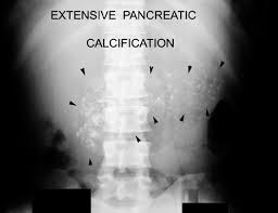 treating pancreatitis