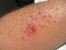 viral infections
