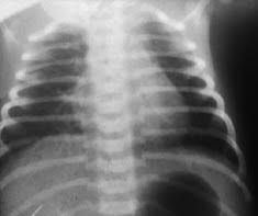 transient tachypnea of the newborn