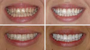 Bleaching of teeth