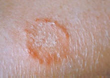 canine ringworm