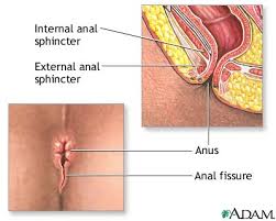 anorectal bleeding