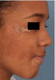 Parry-Romberg syndrome with