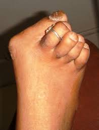 bunion operation