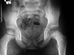 perthes disease