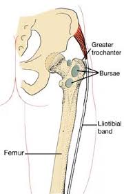 bursitis hip