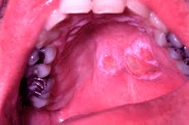 hard palate