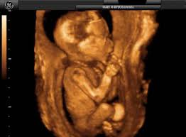 3d ultrasound pictures