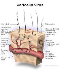 shingles virus