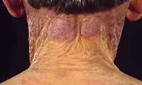 http://t0.gstatic.com/images?q=tbn:mpnUkaqQ1lwzxM:http://www.fvza.org/images/porphyria.jpg&t=1