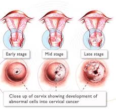 uterus cancer