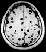 brain cyst