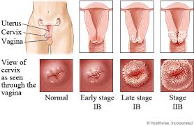 uterus cancer