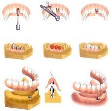 implantes ¿Que ventajas tiene un implante?