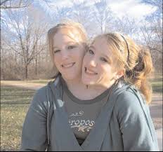 conjoined twins,