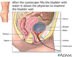 cystoscopy video