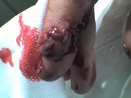 finger cut