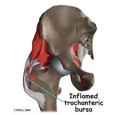 bursitis hip