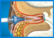 ear lavage syringe
