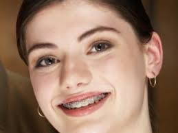 braces pictures