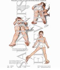 perthes disease