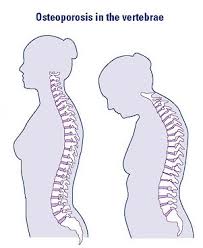 osteoporosis