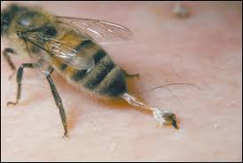bumble bee sting
