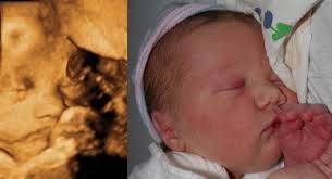 3d sonogram pictures