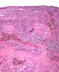 villonodular synovitis and symptoms