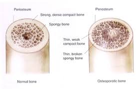 osteoporosis