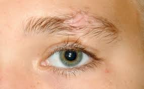 alopecia eyebrow