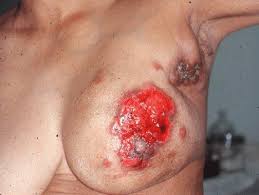 Breast cancer