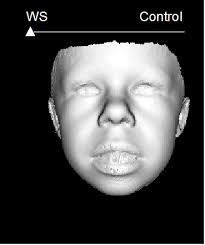 with williams syndrome