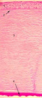 fuchs dystrophy