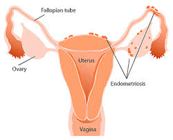 Endometriosis