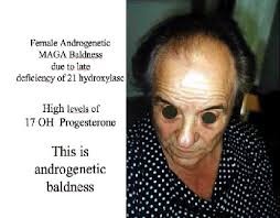 alopecia androgenetica